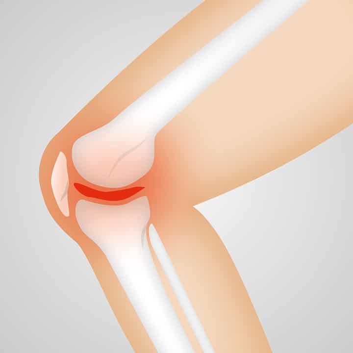 Arthrose symptômes : quels diagnostics ?