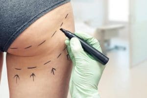 Pourquoi les gens hésitent à faire de la chirurgie esthétique pour leurs fessiers ?