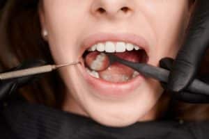Quels avantages et quel prix pour des facettes dentaires en Turquie ?